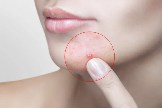 To Eliminate Acne—Ingredients Really Matter