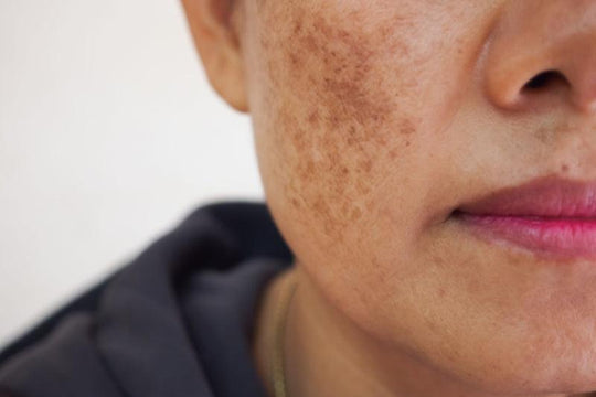 Managing Hyperpigmentation Naturally