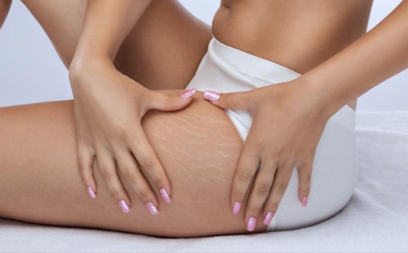 Stressing Over Stretch Marks? - Adonia Organics