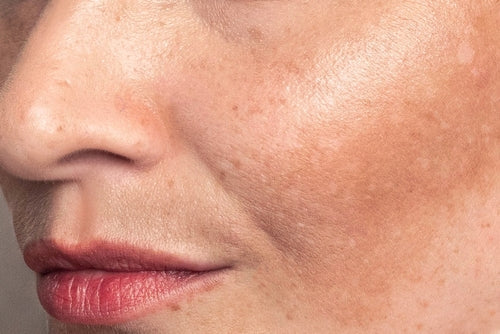 Hyperpigmentation: What Causes Dark Spots
