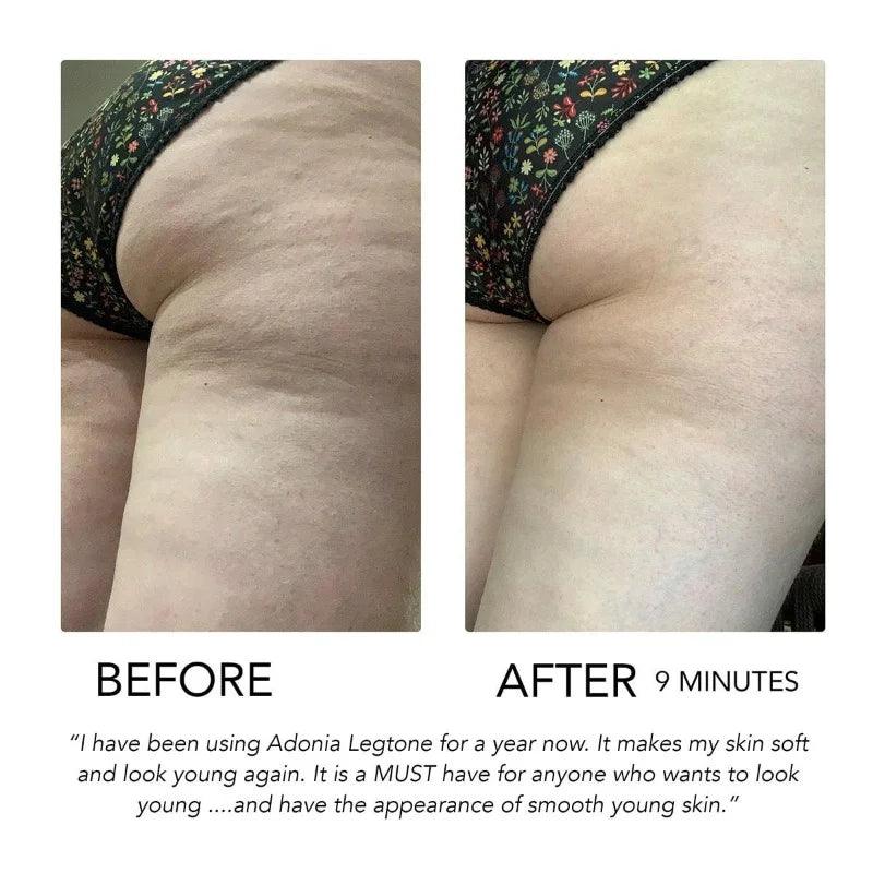 Adonia Legtone - 9 minute Cellulite Serum - Before and After shot