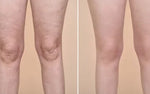 Legs / Cellulite