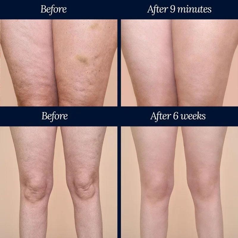 Adonia Legtone - Before and after photos of cellulite
