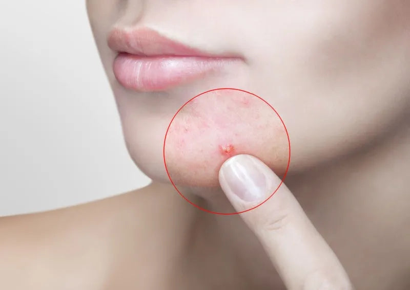 Good and Bad Acne Treatment Ingredients 