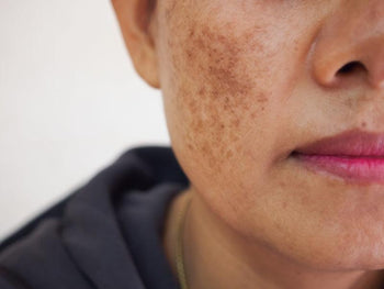 Managing Hyperpigmentation Naturally