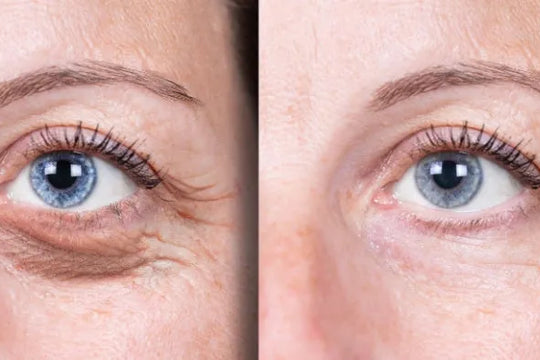 Wrinkles, Wrinkles Go Away!