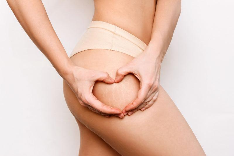 Your Guide to Reducing the Appearance of Stretch Marks - Adonia Organics