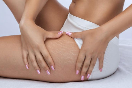 Stressing Over Stretch Marks?