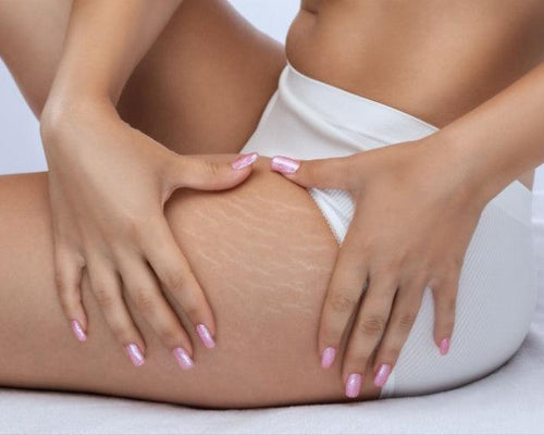 Stressing Over Stretch Marks?