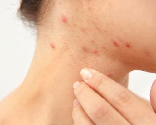 How to Tackle Blemishes and Acne Naturally