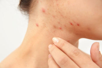 How to Tackle Blemishes and Acne Naturally