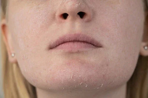 Defeating Dry Skin