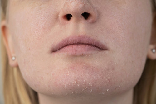 Why Our Skin Gets Dry (and What It Means)