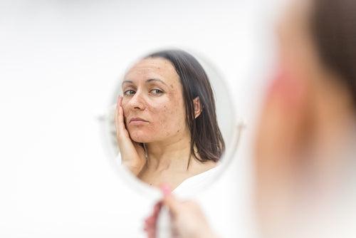 How to Identify a Damaged Skin Barrier