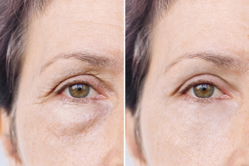 Eliminate Puffiness Naturally