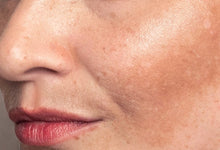 Hyperpigmentation: What Causes Dark Spots