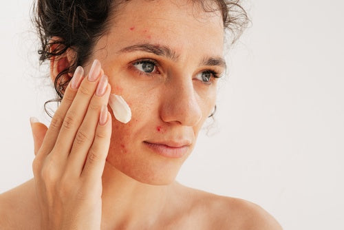 Skincare for Acne-Prone Skin: A Gentle, Natural Approach to Clearer-Looking Skin