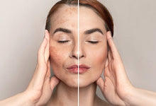 Correcting Skin Discoloration, Naturally