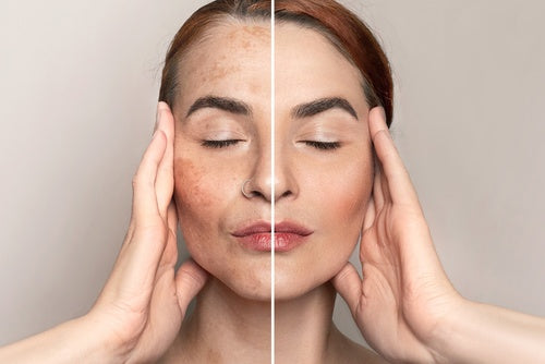 How to Naturally Reduce Excess Melanin Production and Correct Skin Discoloration