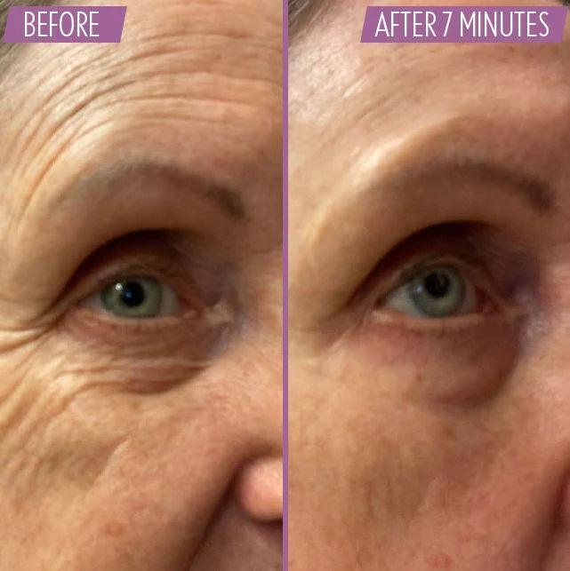 Undereye bag concealer
