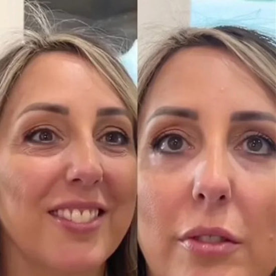 Before and After 7 Minute Lift undereye bags